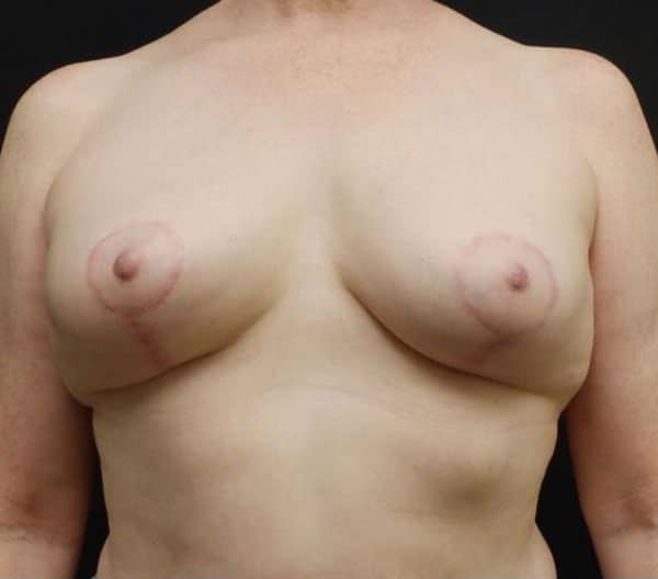 Breast Lift (Mastopexy) — after