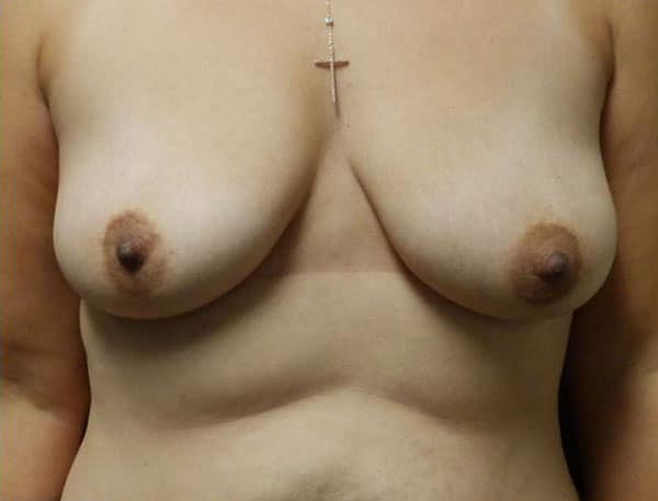 Breast Lift (Mastopexy) — before