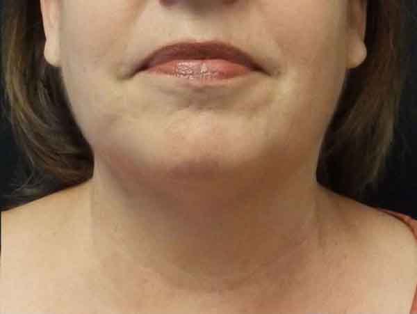 Chin Liposuction — after