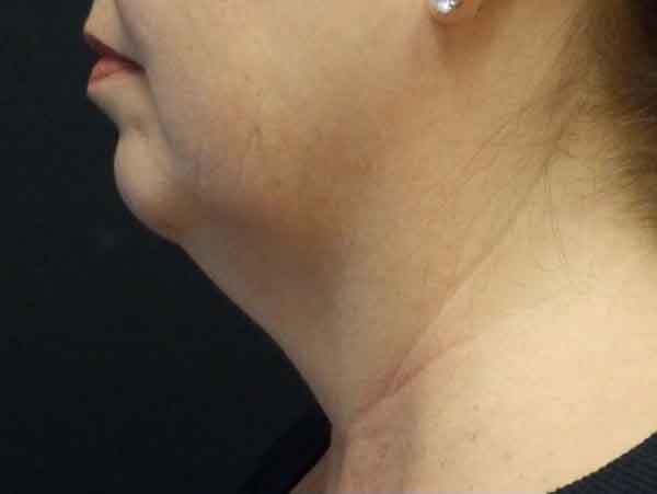 Chin Liposuction — before