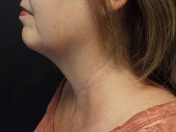 Chin Liposuction — after
