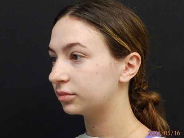 Chin Liposuction — before