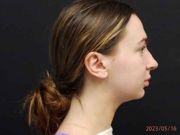 Chin Liposuction — before
