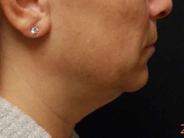 Chin Liposuction — before
