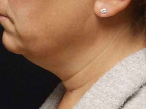 Chin Liposuction — before