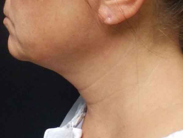 Chin Liposuction — after