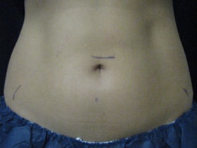 CoolSculpting® before and after photos