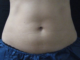 CoolSculpting — after