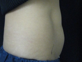 CoolSculpting — before