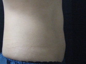 CoolSculpting — after