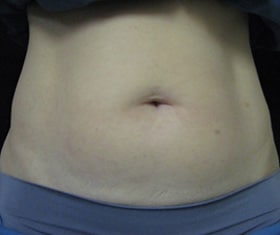 CoolSculpting — before