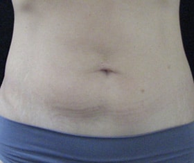 CoolSculpting — after