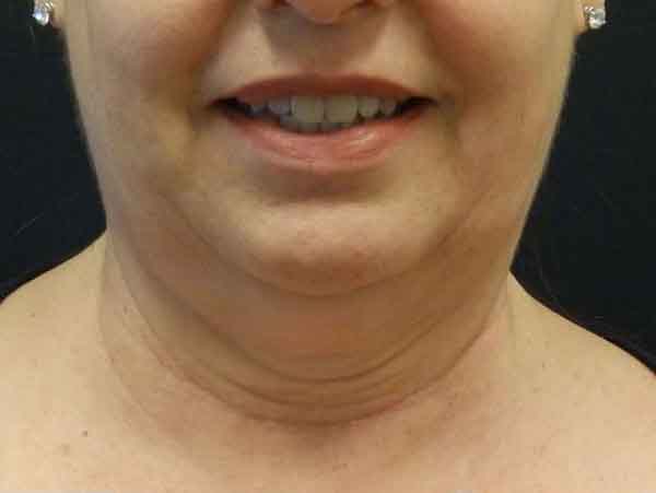 Face Procedures before and after gallery