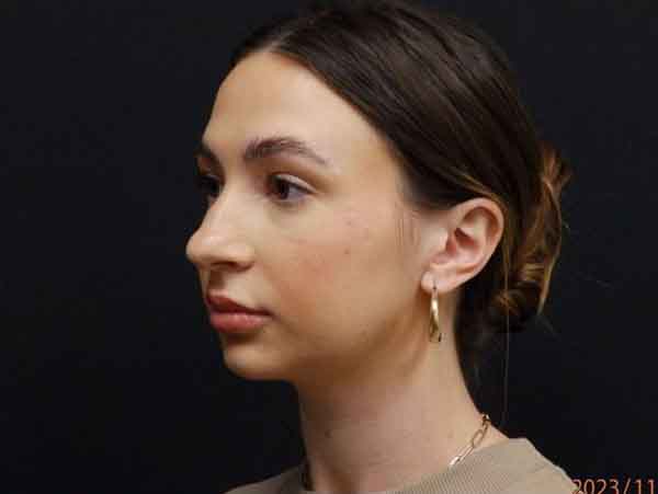 Face Procedures — after