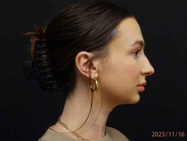 Face Procedures — after