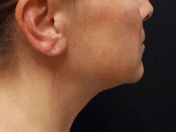Face Procedures — after