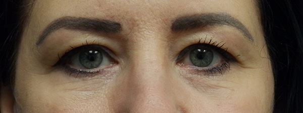 Face Procedures — before