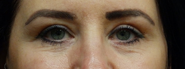 Face Procedures — after
