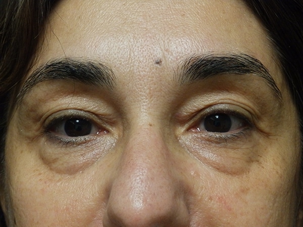 Face Procedures — before