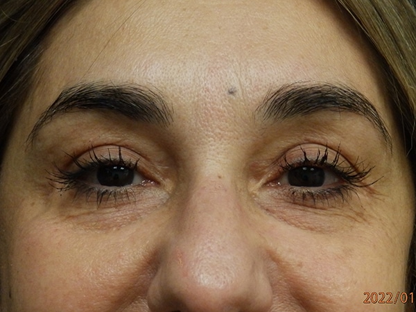 Face Procedures — after