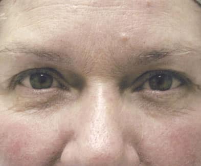 Face Procedures — before