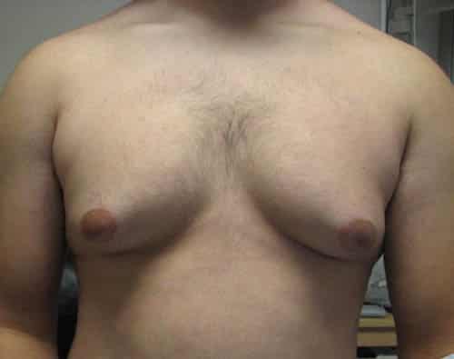 Male Breast Reduction before and after photos