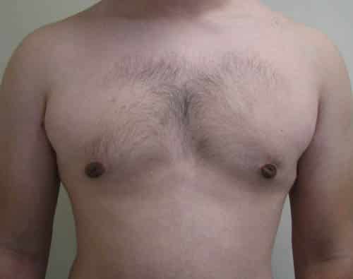 Gynecomastia (Male Breast Reduction) — after