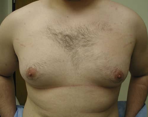 Gynecomastia (Male Breast Reduction) — before