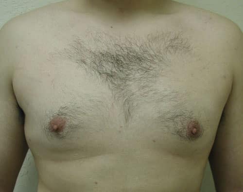 Gynecomastia (Male Breast Reduction) — after