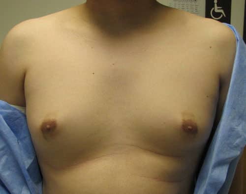 Gynecomastia (Male Breast Reduction) — before