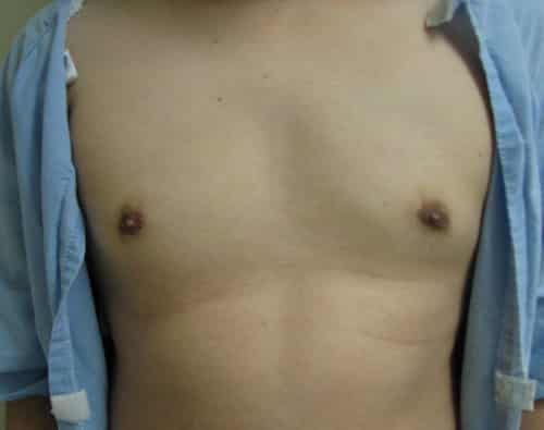 Gynecomastia (Male Breast Reduction) — after