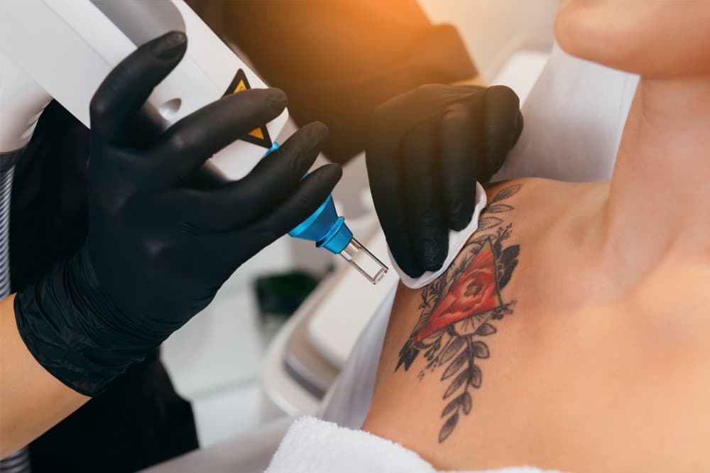 Laser Tattoo Removal before and after gallery