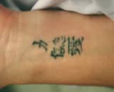 Laser Tattoo Removal before and after photos