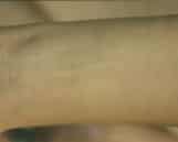 Laser Tattoo Removal — after