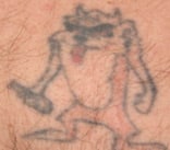 Laser Tattoo Removal — before