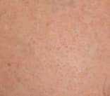 Laser Tattoo Removal — after