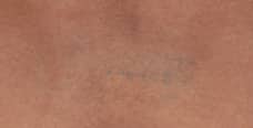 Laser Tattoo Removal — after