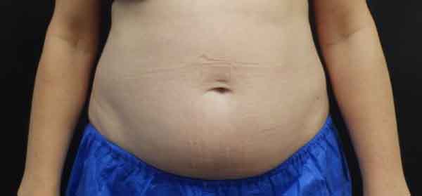 Liposuction before and after gallery