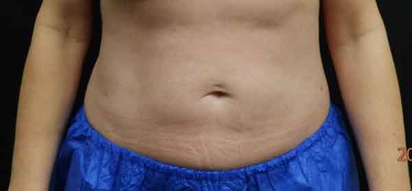 Liposuction — after