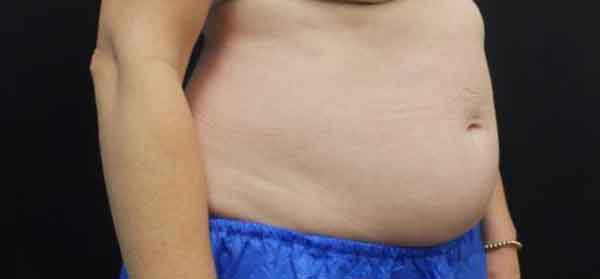 Liposuction — before