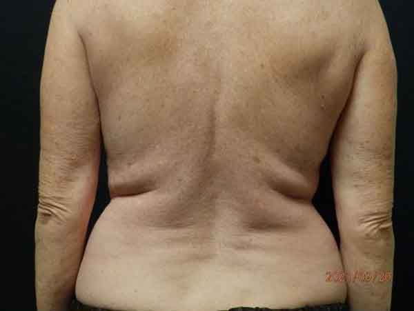 Liposuction — before