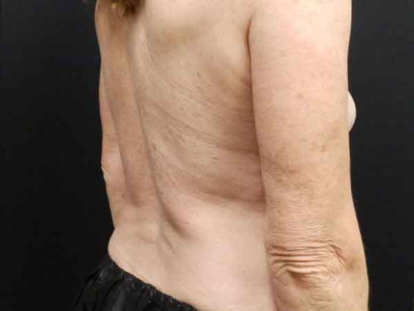 Liposuction — after