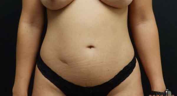 Liposuction — before