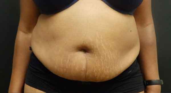 Liposuction — before