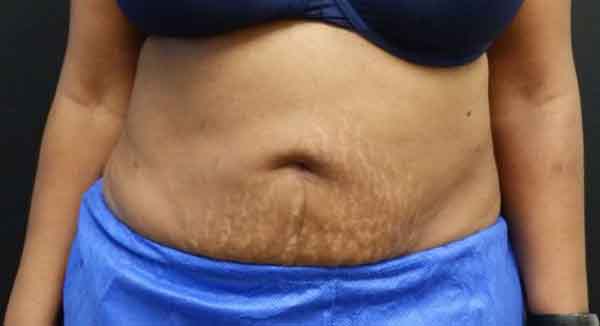 Liposuction — after