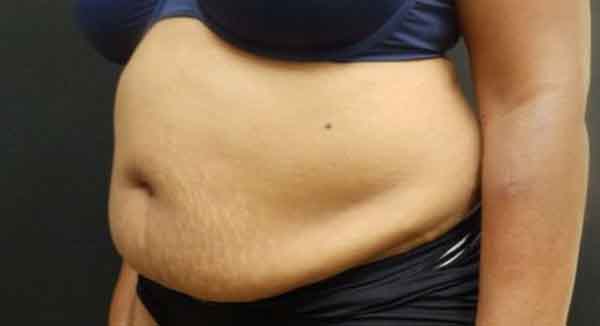 Liposuction — before