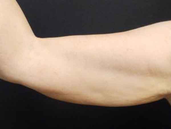 Liposuction — before