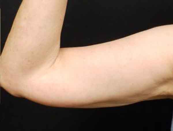 Liposuction — after