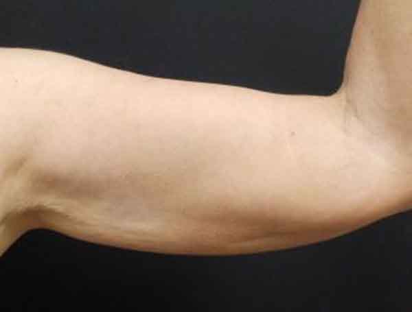Liposuction — before
