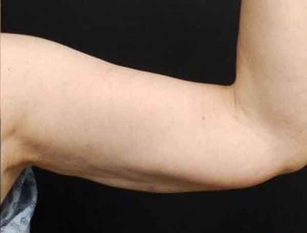 Liposuction — after